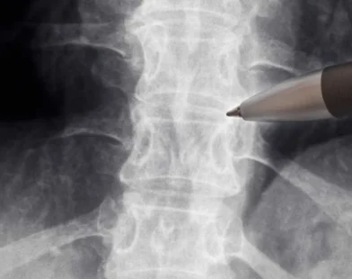 Anvisa libera estudo com medicamento para lesões na medula espinhal