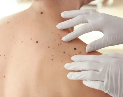 Casos de câncer de pele saltam de 4 mil para mais de 72 mil em 10 anos